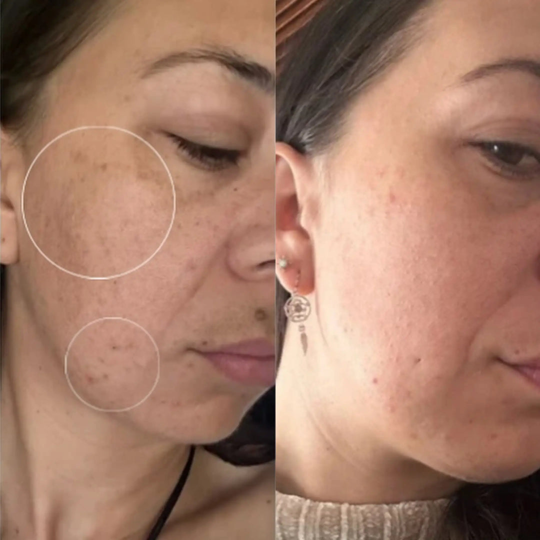 Before and after comparison of a woman's face with visible skin imperfections. best moisturiser for dry skin