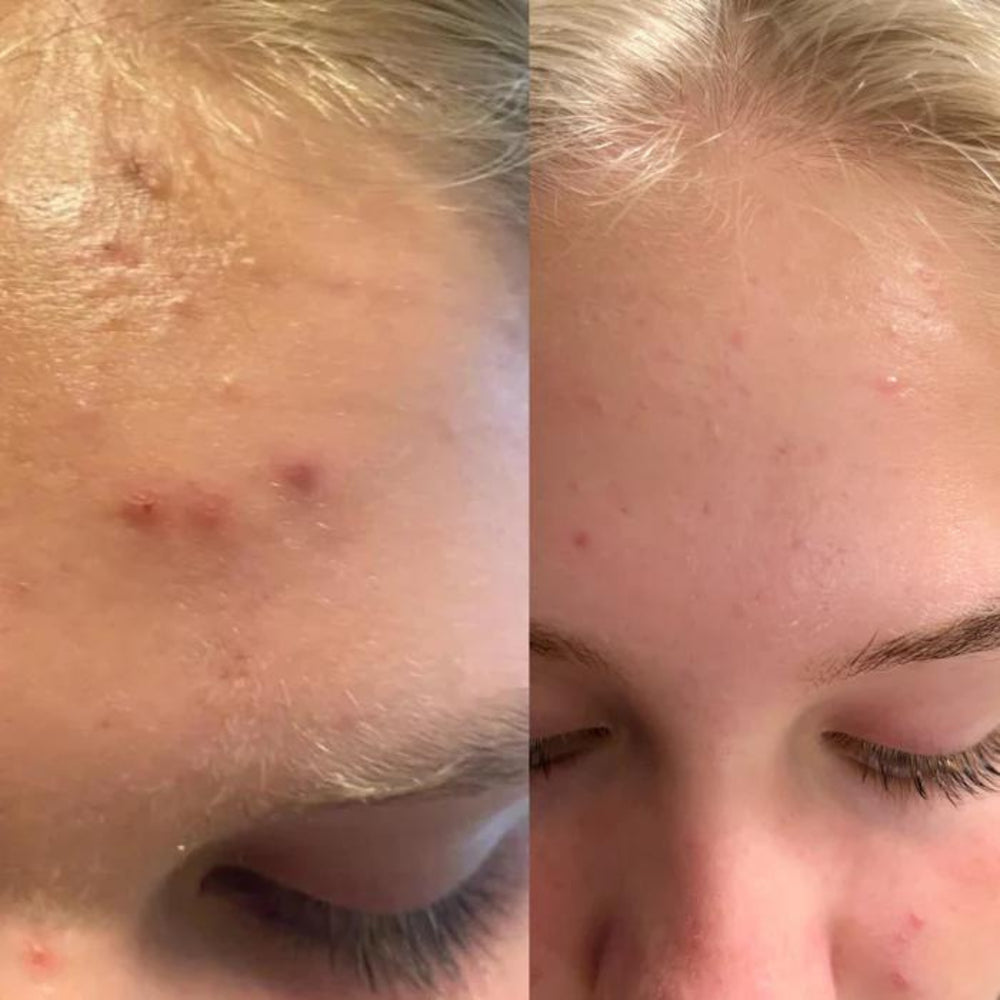 A before and after comparison photo of a person's forehead showing the effects of a skincare treatment. On the left, the before image, the forehead has several visible blemishes and acne. On the right, the after image, the skin appears clearer with reduced redness and fewer blemishes, suggesting an improvement in skin condition.