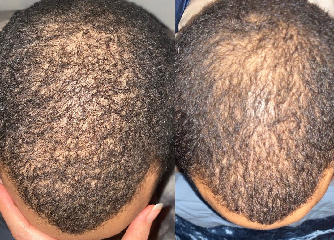 before and after using rosemary hair oil for hair treatment