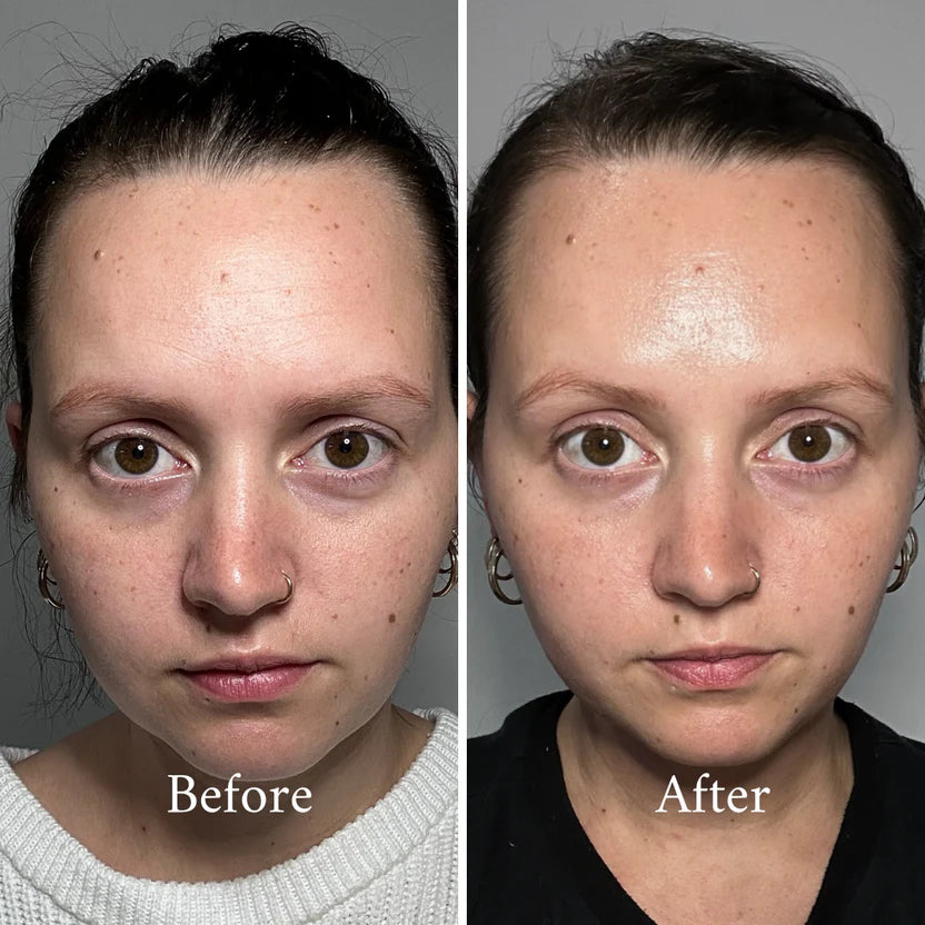 Before and after comparison photos of a woman’s face, showcasing the clear skin results using Tidhá Botanical Face Oil, resonating with Australian skincare users.