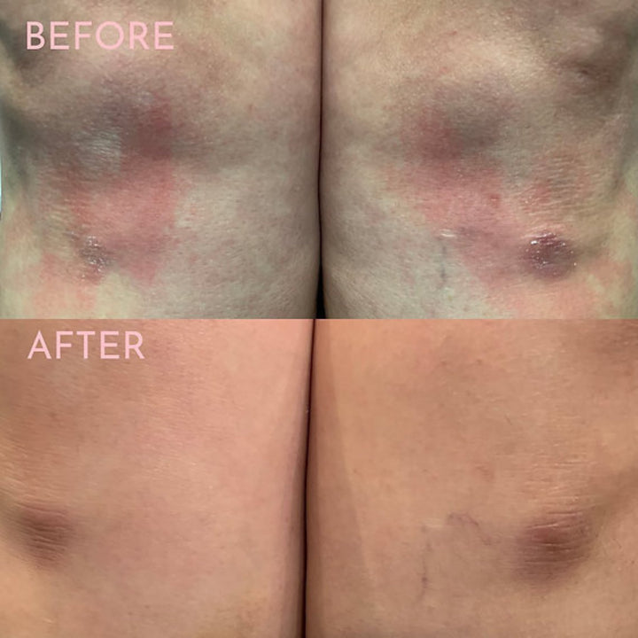 Before and after images showing the effectiveness of an exfoliating body scrub from Oat Body. The 'Before' photo shows skin with redness and blemishes, while the 'After' photo shows the same skin area with a visibly reduced appearance of blemishes and a more even skin tone, demonstrating the skin-calming benefits of the product.