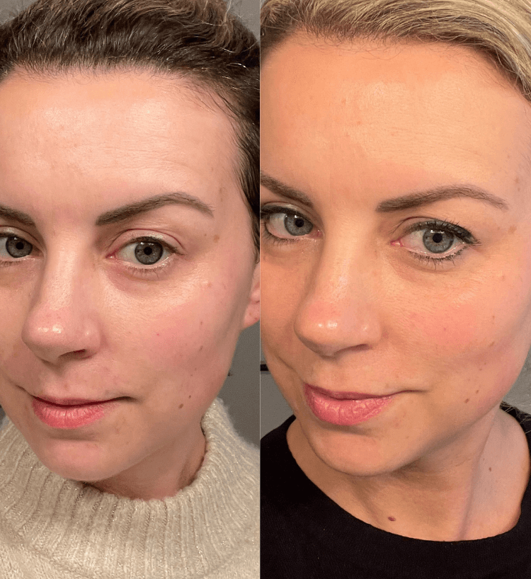 Face oil for acne prone skin. Before and after comparison of a woman's face with visible makeup changes.