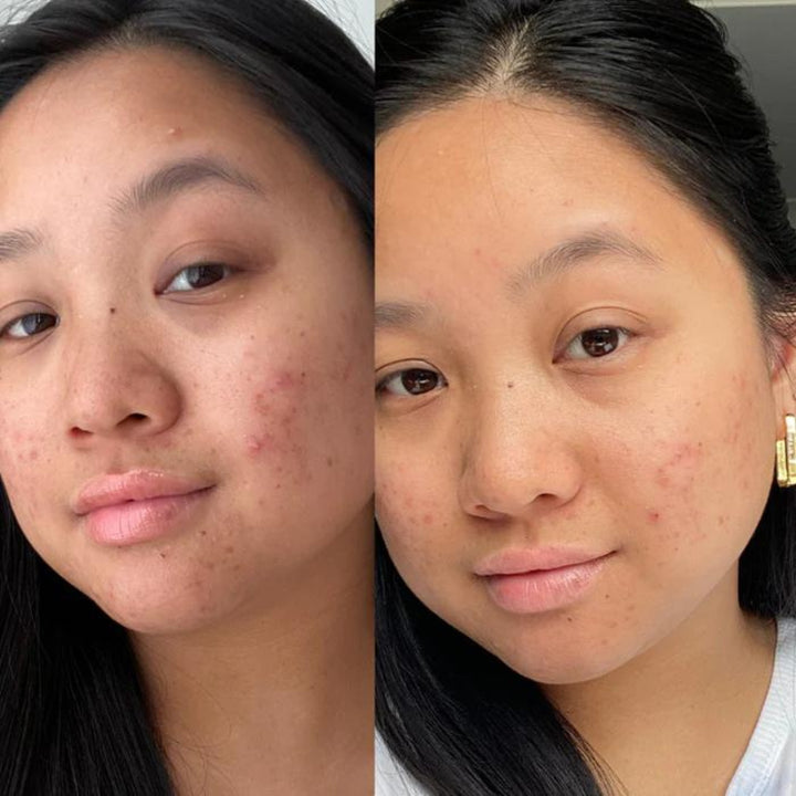 A split-image showing the before and after results on a woman's face from a skincare regimen. The left side of the image shows her face with visible acne and blemishes. The right side, after treatment, shows her skin with a noticeable reduction in blemishes and a smoother complexion, indicating an improvement from the skincare products used.