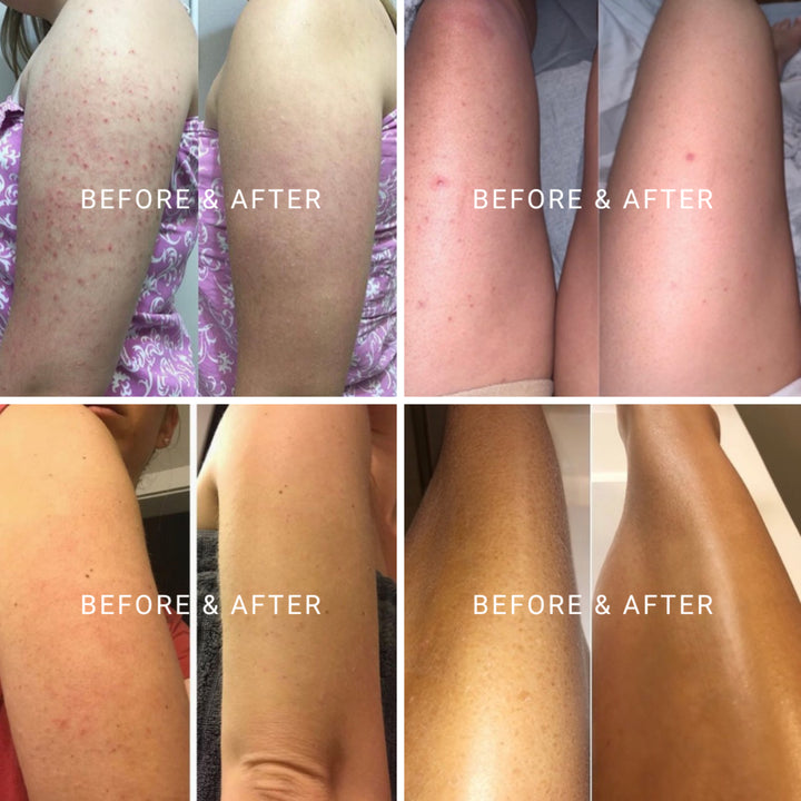Four sets of before and after photos showing skin improvement on legs, results of using body exfoliant and body scrub in Australia.