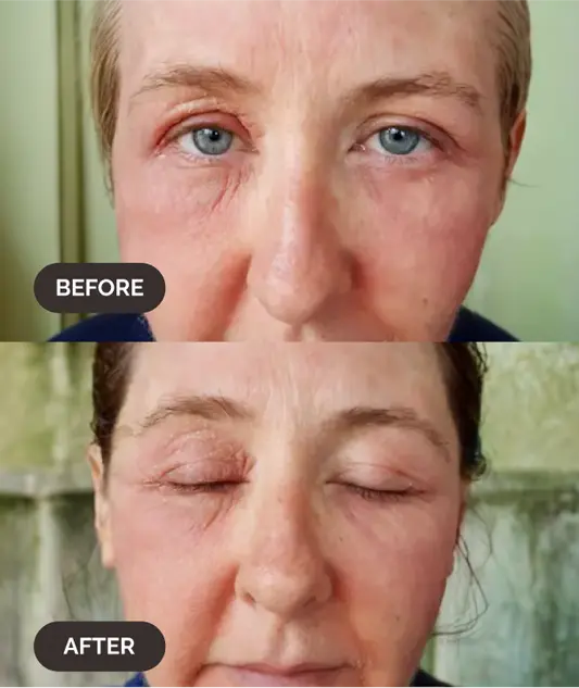 Before and after results showing reduced skin redness using LAMAV Hydra-Calm