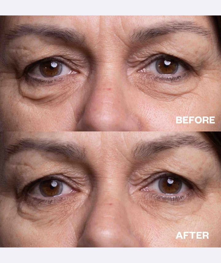 Before and after using Wrinkles Schminkles under-eye wrinkle patches on mature eyes