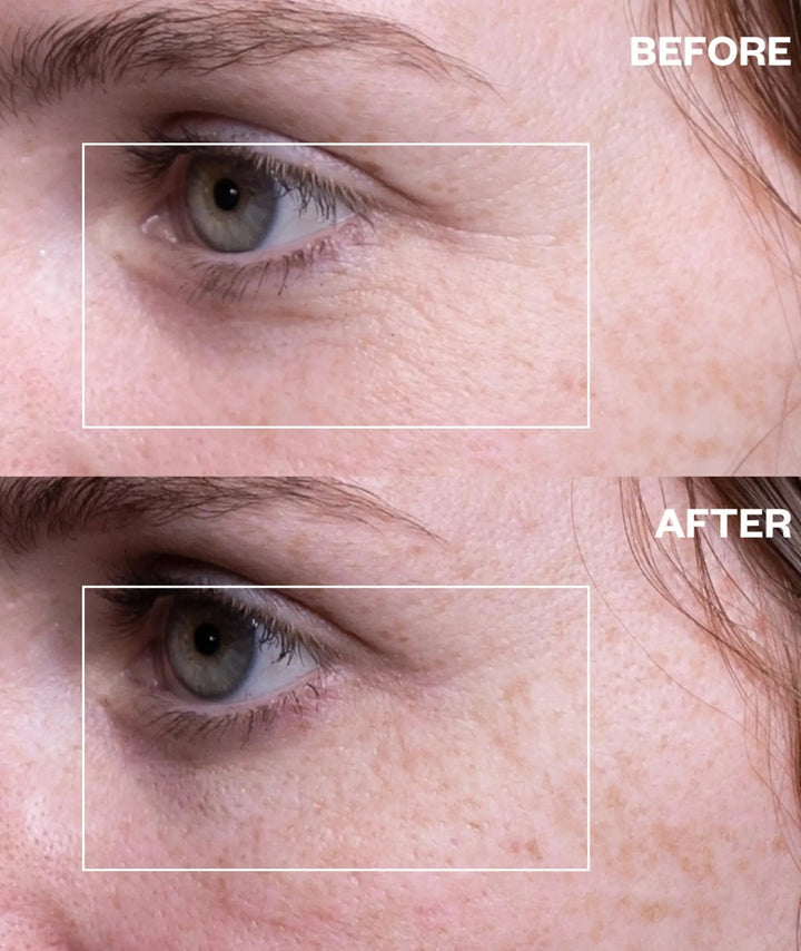 Before and after using Wrinkles Schminkles under-eye wrinkle patches